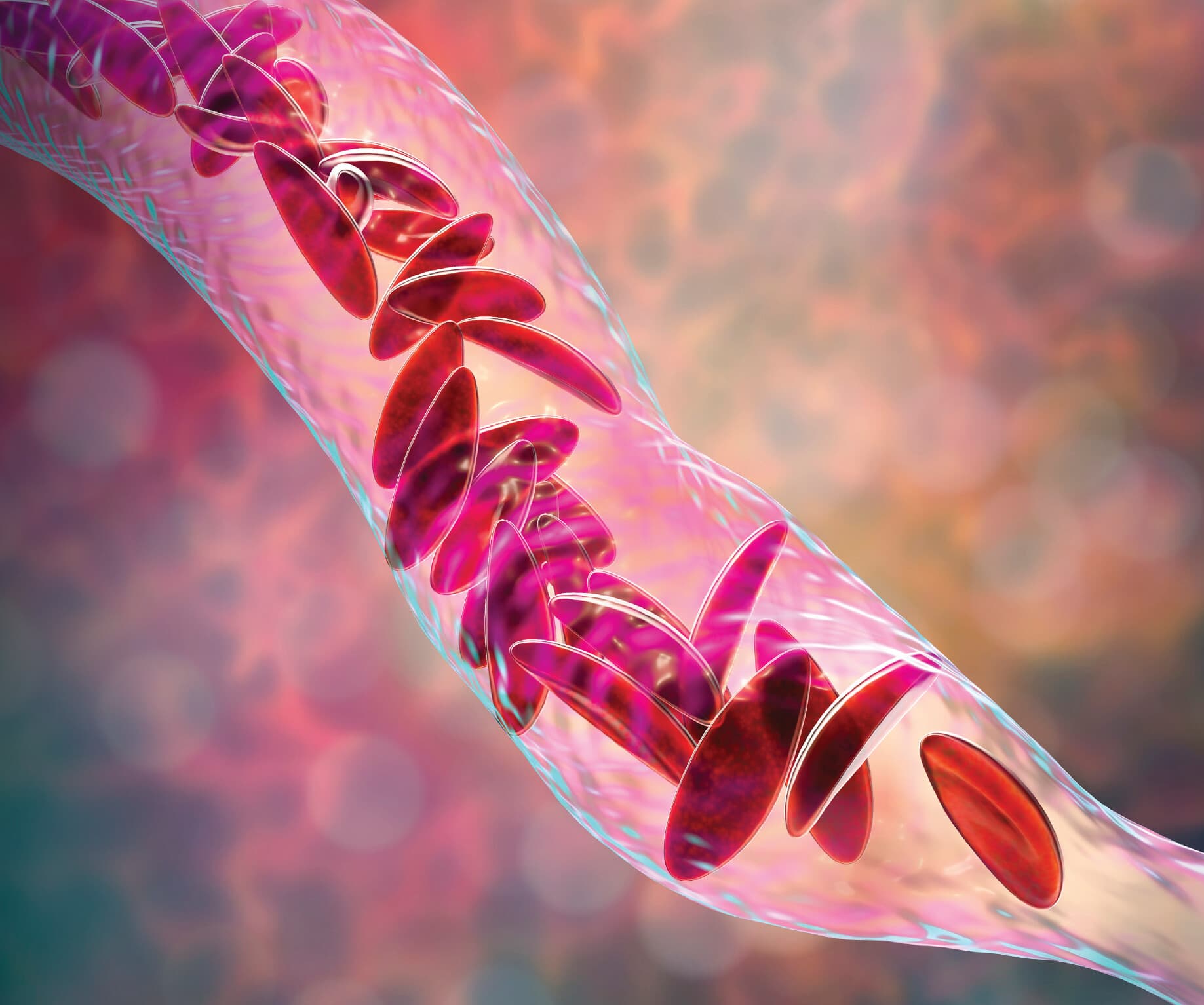 CRISPR's Utilization To Inhibit Sickle Cell Disease